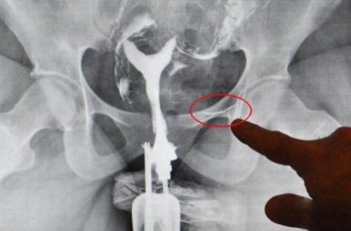 Uşağı olmayan azərbaycanlı qadın rentgenə baxanda ŞOK OLDU - 16 il əvvəl...