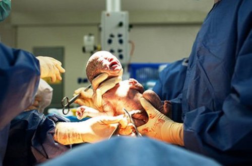 Həkim yeni doğulan körpəni şikəst etdi