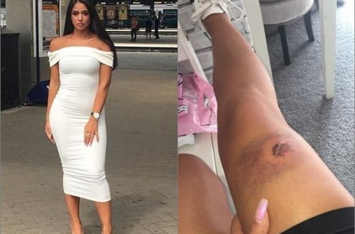 Modelin dişlədiyi qadına peyvənd vuruldu