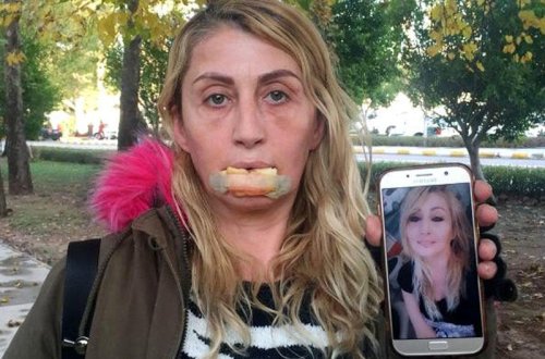 Qadının qarnındakı piydən üzünə dolğu etdilər, dodağı çürüdü - FOTO