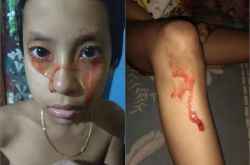 Восьмилетняя девочка начала потеть и плакать кровью - ВИДЕО