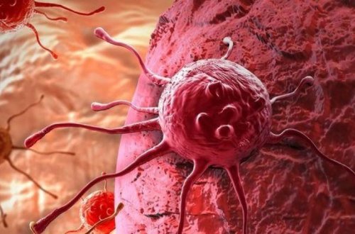 Онкологи назвали способ защититься от рака груди