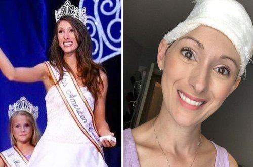 Бывшей королеве красоты после инсульта удалили часть черепа