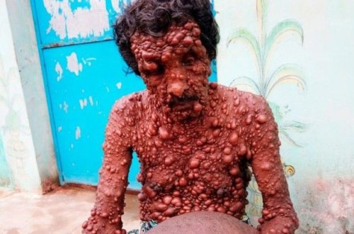 Hindistanda yaşayan kişinin bütün bədəni xoşxassəli şişlə örtülüb - FOTO