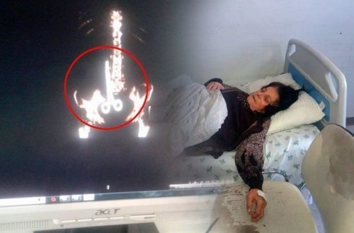 Xəstənin qarnında qayçı unudulması ilə bağlı açıqlama: “Həkim robot deyil ki!” - VİDEO