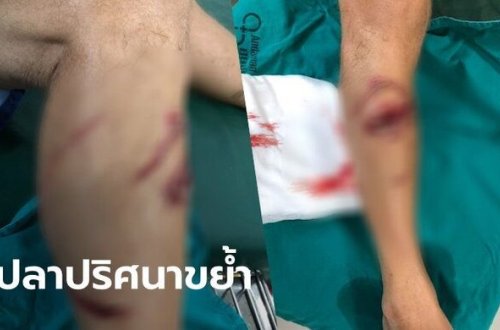 Bulanıq suda üzən turistin ayağını köpəkbalığı dişlədi - DƏHŞƏTLİ FOTO