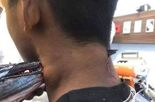 Sudan tullanan balıq oğlanın boynunu deşdi - FOTO