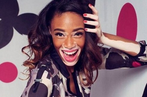 Модель с пятнистой кожей попала на обложку модного журнала - ФОТО