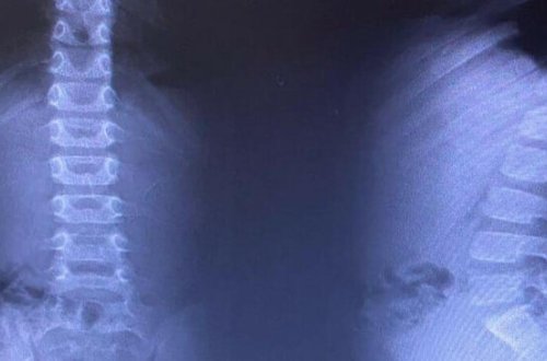 Bakıda 8 maqnit udan uşaq əməliyyat edildi - FOTO