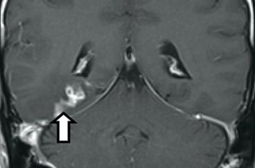 Baş ağrıları ilə həkimə gəldi: beynindən qurd çıxdı