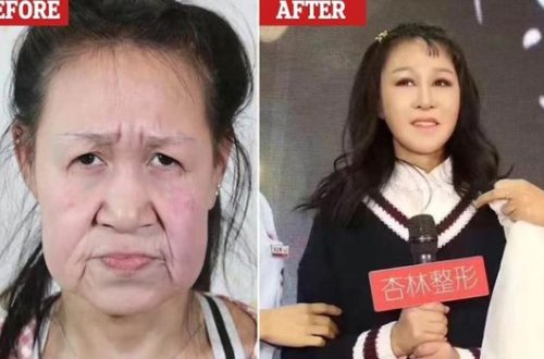 Qoca sifətli yeniyetmə əməliyyatdan sonra gözəlliyi ilə hamını təəcübləndirdi – FOTO/VİDEO