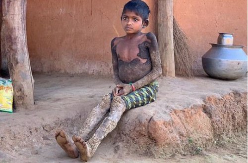 Ağır xəstəlik yeddi yaşlı qızı “daşa döndərir” – FOTO/VİDEO