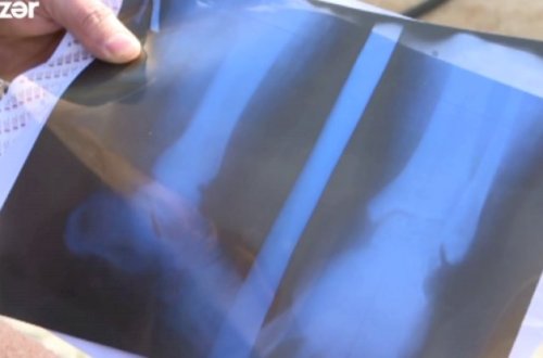 Azərbaycanda həkim sınıq olmayan ayağa gips qoydu - ŞOK İDDİA - VİDEO