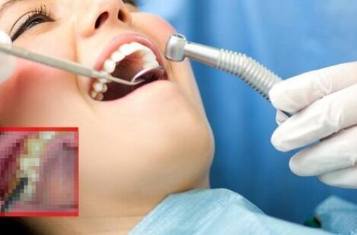 Diş həkiminə müraciət edən qadının ağız boşluğundan çıxanlar şoka saldı - FOTO