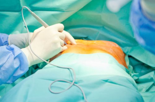 Həkimlər qadının iki əlavə döşünü kəsdilər