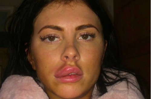 Şişirdilmiş dodağının partlaması qadını kor edəcəkdi - FOTO