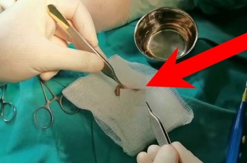 Azərbaycanda sünnət zamanı uşağın cinsiyyət orqanı kökündən kəsildi - ŞOK VİDEO