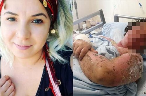 Gənc qadın antibiotiklərə görə tanınmaz hala düşdü - VİDEO