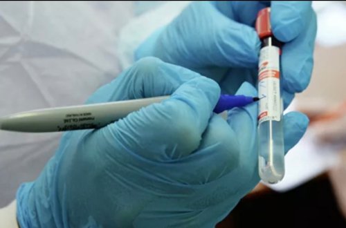 Rusiyada gün ərzində koronavirusa yoluxanların sayı 53 nəfər olub