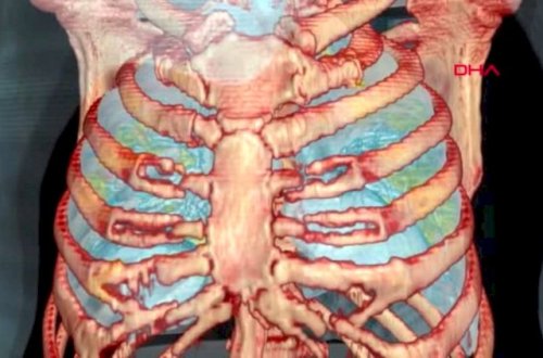 Koronavirusa yoluxanların ağciyərləri bu hala düşür - Video