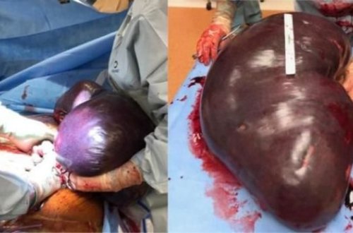 ABŞ-da cərrahlar tibb tarixində ən böyük dalağı çıxarıblar