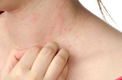 Dermatoloqlar koronavirusun daha bir simptomunu aşkar ediblər