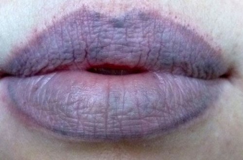 Koronavirusun daha bir simptomu üzə çıxdı