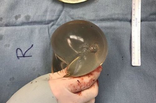 Silikon sinə qadını ölümdən xilas etdi