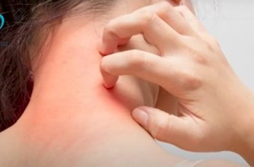 Koronaviruslu xəstələrin dərisində bu dəyişikliklər olur - Video