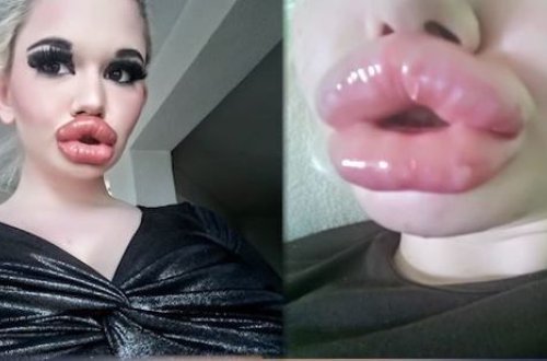 Bolqarıstanlı model dodaqlarını o qədər böyüdüb ki, yemək yeyə bilmir - FOTO