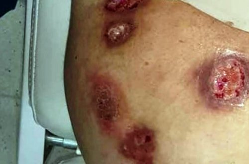 Bakıda “popo böyütmə” əməliyyatı etdirən qadının bədəni bu hala düşüb – Yara cərrahından AÇIQLAMA - VİDEO