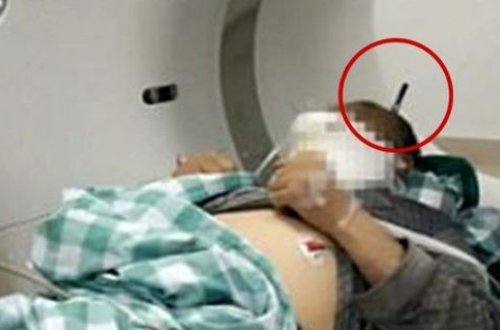 Başına 20 sm uzunluğunda dəmir parçası batmış fəhlə sağ qaldı - FOTO