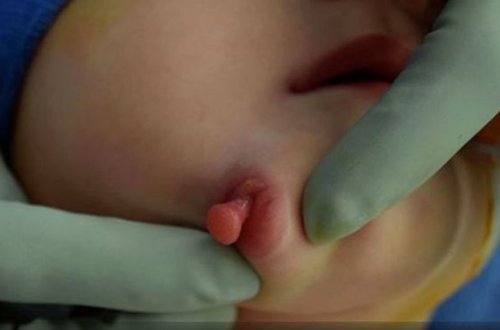 İki ağzı və iki dili olan uşaq dünyaya gəldi - FOTO