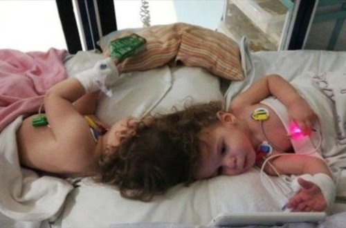 Siam əkizlərini ayırdılar - FOTO