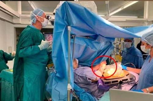 Qadın beyin əməliyyatı zamanı dolma hazırladı - VİDEO