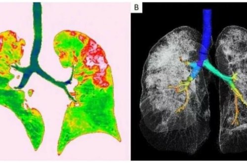 Koronavirusdan sağalanların ağciyərlərində elə şeylər tapıldı ki... - Dəhşətə gələcəksiniz