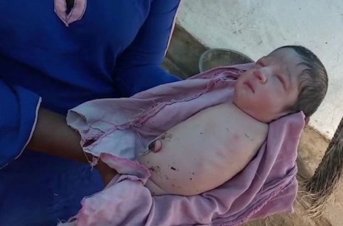 Anasının bətnində normal görünən körpə əlsiz-ayaqsız doğuldu