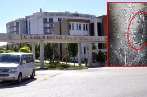 Ağrılarla xəstəxanaya müraciət etmiş şəxsin bədənindən butulka çıxdı - FOTO