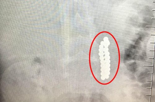 Qarnı ağrıyan uşağın mədəsindən çıxanlar həkimi də DƏHŞƏTƏ GƏTİRDİ - VİDEO - FOTO