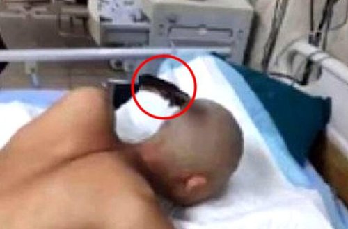 Başına bıçaq sancılmış kişi təmkini ilə təəccübləndirdi