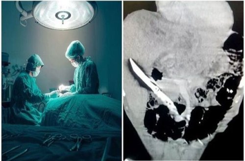 Kişi 20 santimetrlik bıçağı uddu və sağ qaldı - FOTO