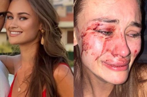 Cazibədar model Türkiyədə döyüldü - FOTO