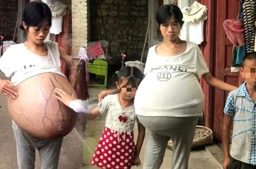 Qarınında 20 kiloluq kütlə daşıyan qadın həkimləri MAT QOYDU - FOTO-VİDEO