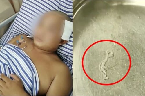 Gəncin beynindən orada 17 il yaşamış canlı qurd çıxarılıb - FOTO/VİDEO