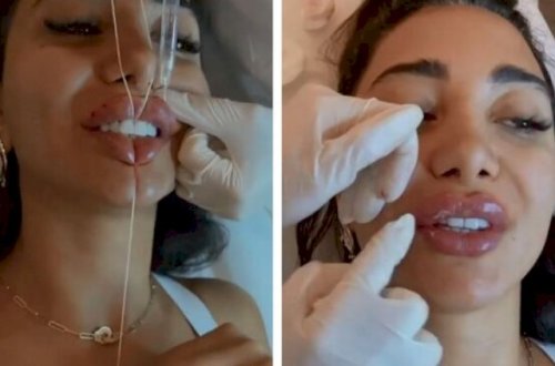 “Lider“ TV-nin aparıcısı dodağını şişirtdi, tənqid olundu + Video
