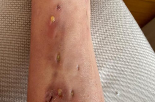 Bakıda dolğu etdirən gənc xanımın ayaqları çürüdü - FOTO