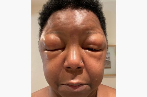 Женщина покрасилась в домашних условиях и наутро не смогла открыть глаза - ФОТО