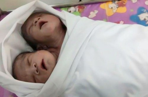 Yeni doğulan körpə hamını şoka saldı - iki başı var