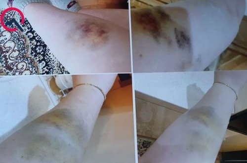 “Ərim məni dəfələrlə döysə də, polis olduğu üçün cinayət işi açılmır”