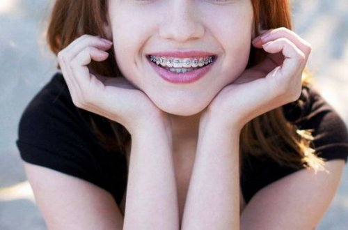 Breket qoyduran qadının ağzında xərçəng yarandı